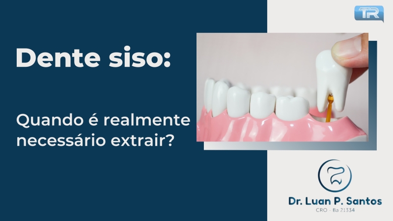 Dente siso: Quando é realmente necessário extrair?