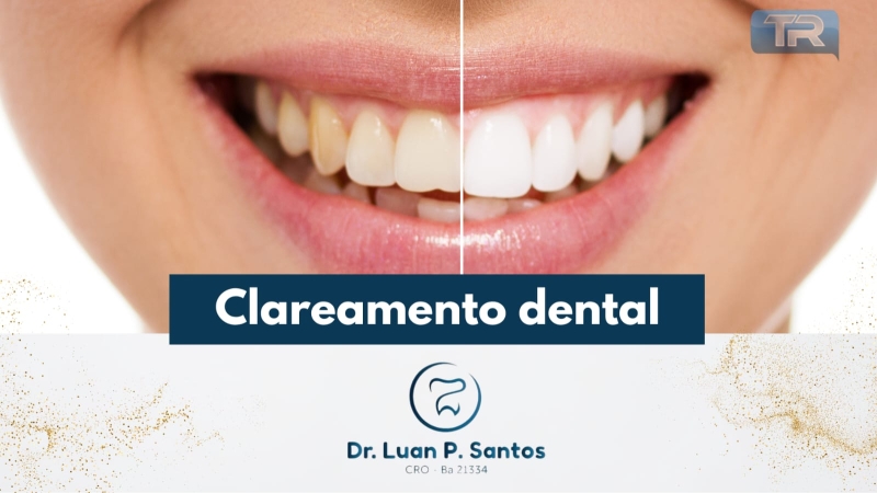 Clareamento dental