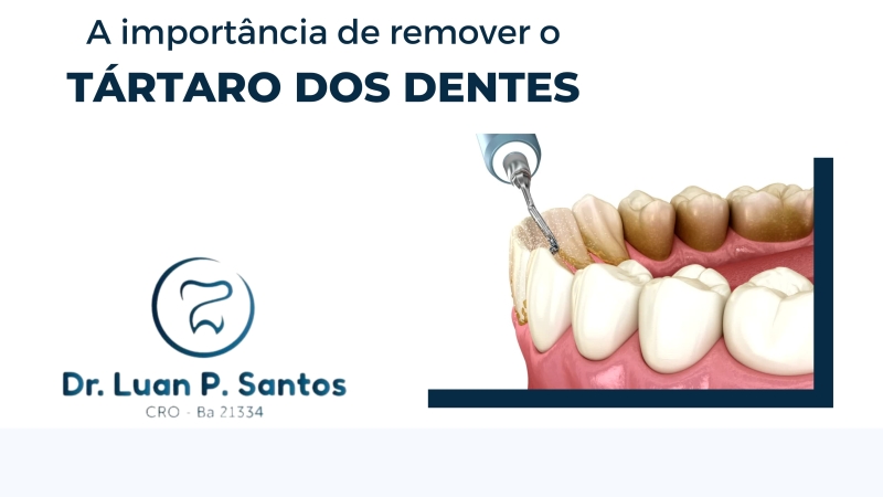 A importância de remover o tártaro dos dentes